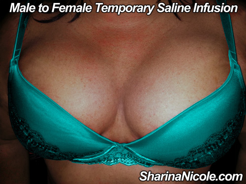Male to female feminization with temporary saline breast infusion